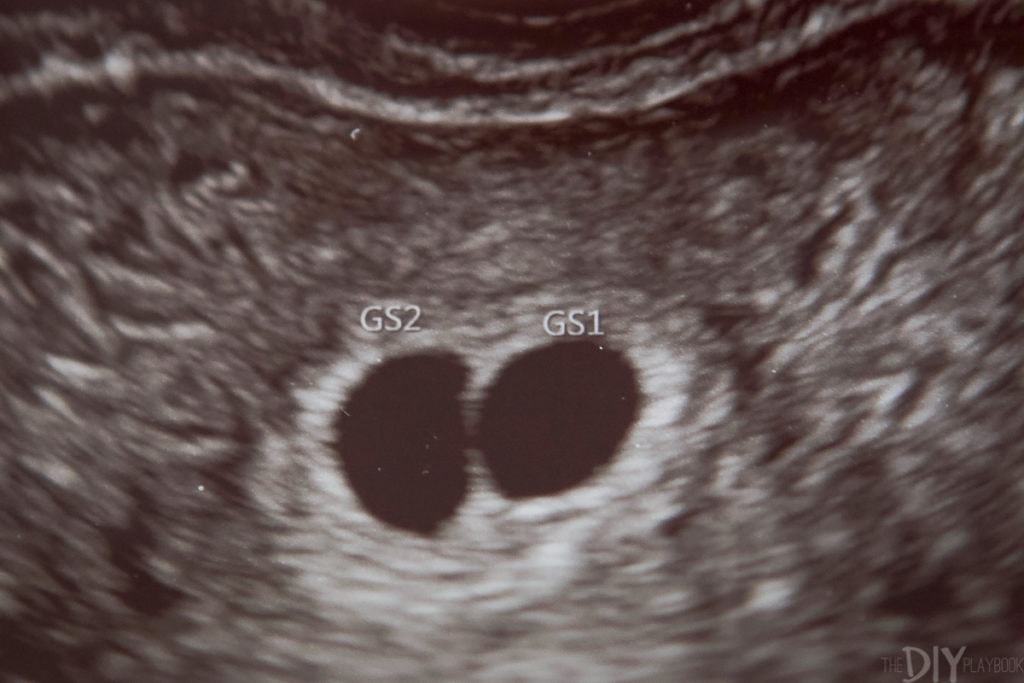 IVF 2 gestational sacs