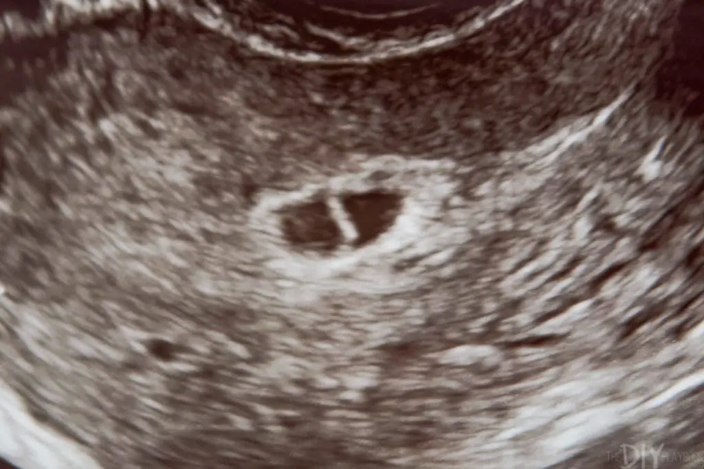 6 week ultrasound fetal pole