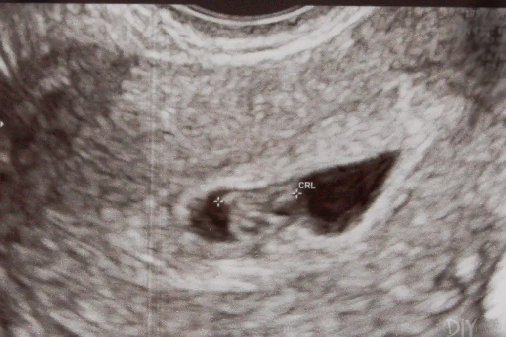 IVF 7 weeks ultrasound