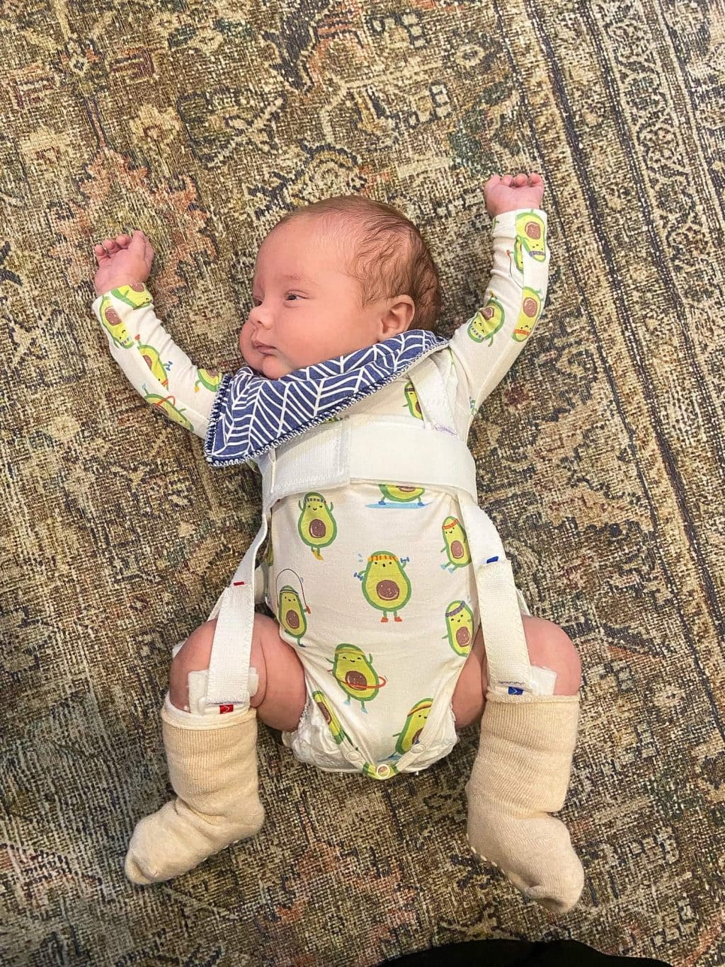 Infant hip dysplasia, wearing a Pavlik harness